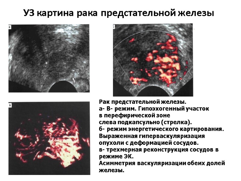 УЗ картина рака предстательной железы         Рак